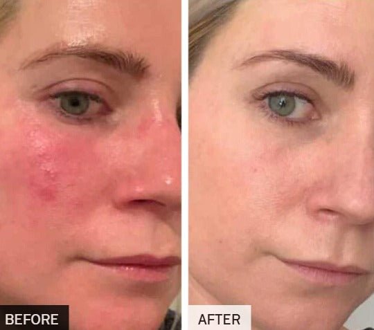 Lichttherapie Gezichtsmasker - VelvetRoots