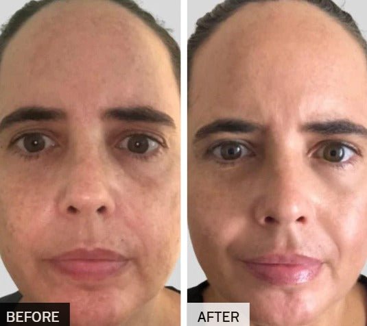 Lichttherapie Gezichtsmasker